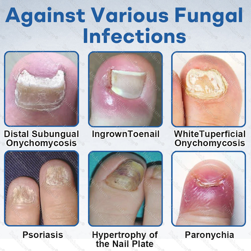 Healrize®Nano Rapid Clear Nail Fungus Rapair Liquid🔥 – Effective in Seven Days, Permanently Eliminates the Root
