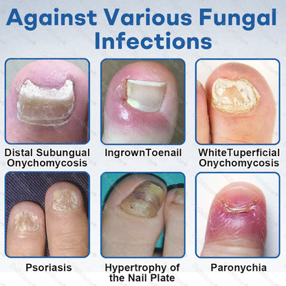 Healrize®Nano Rapid Clear Nail Fungus Rapair Liquid🔥 – Effective in Seven Days, Permanently Eliminates the Root