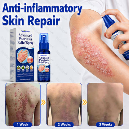 Dobshow® ❄️Advanced Psoriasis Relief Spray