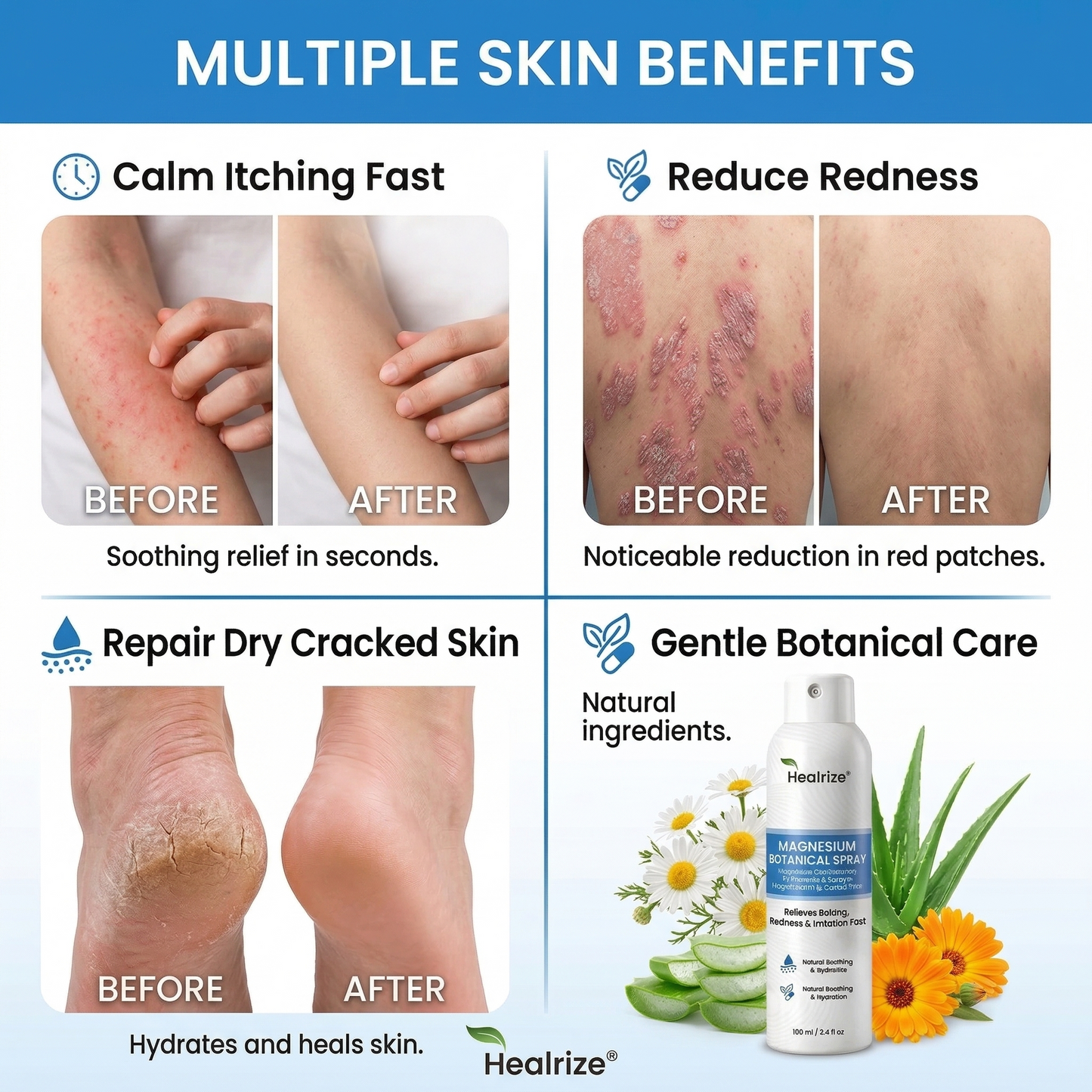 👨‍⚕️Healrize® Magnesium Botanical Spray – 🍃Advanced Skin Recovery for Psoriasis & Eczema | Rapid Soothing, Steroid-Free