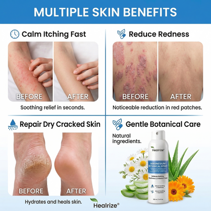 👨‍⚕️Healrize® Magnesium Botanical Spray – 🍃Advanced Skin Recovery for Psoriasis & Eczema | Rapid Soothing, Steroid-Free