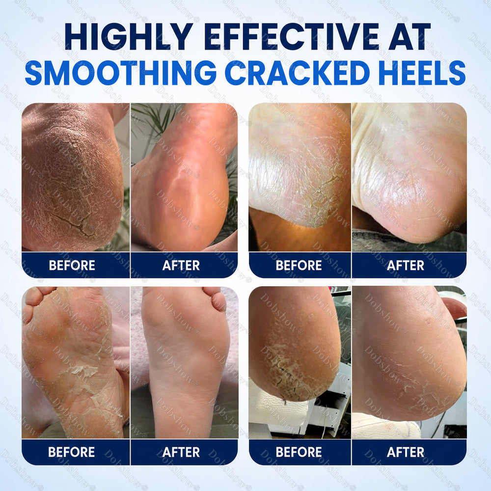 Dobshow® 2% Salicylic Acid Callus & Cracked Heel Spray