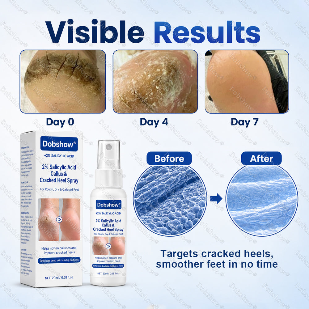 Dobshow® 2% Salicylic Acid Callus & Cracked Heel Spray