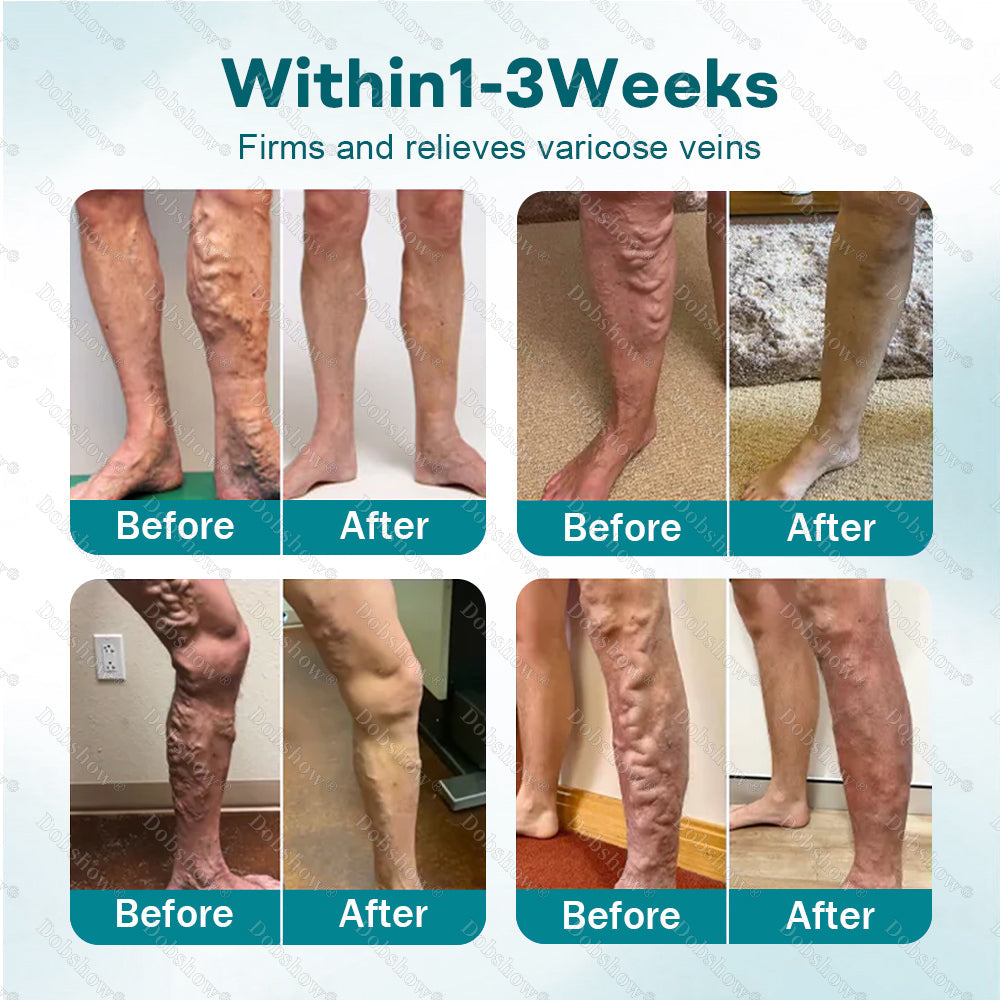 👨‍⚕️✅Healrize® Rapid Vein Relief Microdarts | 7-Day Visible & ALL SKIN TYPES ✨