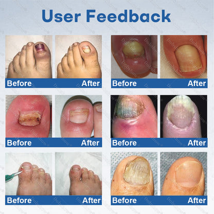 Healrize®Nano Rapid Clear Nail Fungus Rapair Liquid🔥 – Effective in Seven Days, Permanently Eliminates the Root