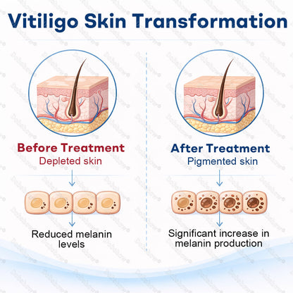 🔥Healrize® Piperine Vitiligo Repigmentation Spray - 👨‍⚕️🌿Steroid-Free Botanical Formula | Gentle & Effective for All Skin Types