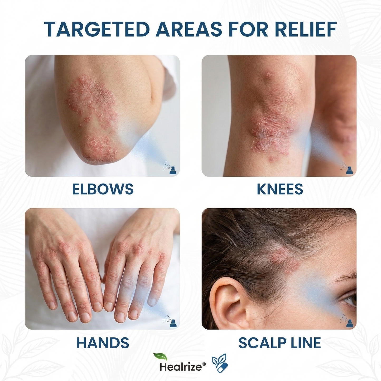 👨‍⚕️Healrize® Magnesium Botanical Spray – 🍃Advanced Skin Recovery for Psoriasis & Eczema | Rapid Soothing, Steroid-Free