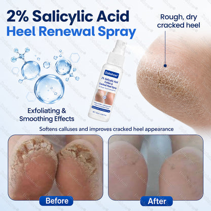 Dobshow® 2% Salicylic Acid Callus & Cracked Heel Spray