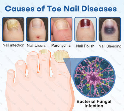 Healrize®Nano Rapid Clear Nail Fungus Rapair Liquid🔥 – Effective in Seven Days, Permanently Eliminates the Root