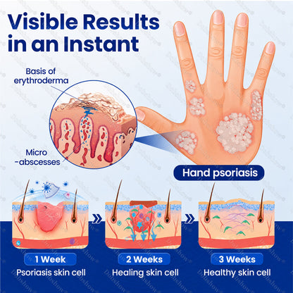 Dobshow® ❄️Advanced Psoriasis Relief Spray