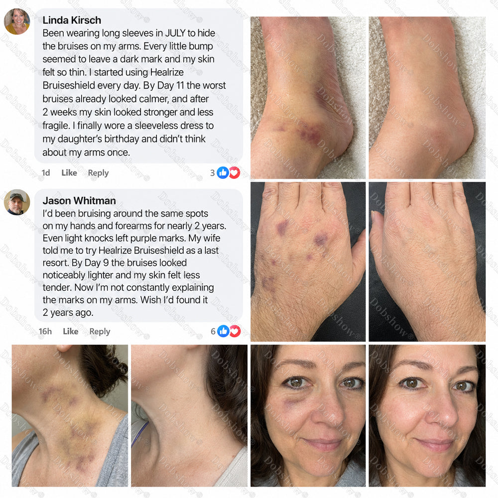 Dobshow® BRUISESHIELD Skin Strengthening Cream ——Z