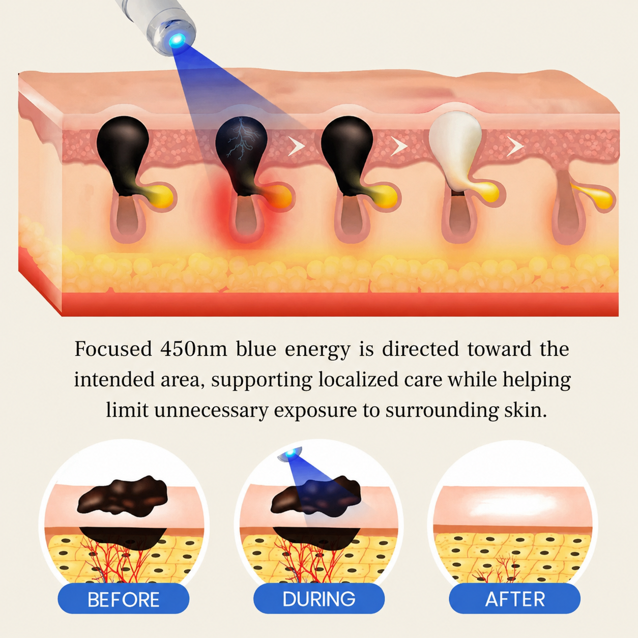 Nurbini® 💙Non-Invasive Mole & Wart Pen | Precision Care for Common Warts, Moles & Skin Tags
