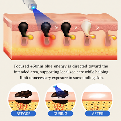 Nurbini® 💙Non-Invasive Mole & Wart Pen | Precision Care for Common Warts, Moles & Skin Tags