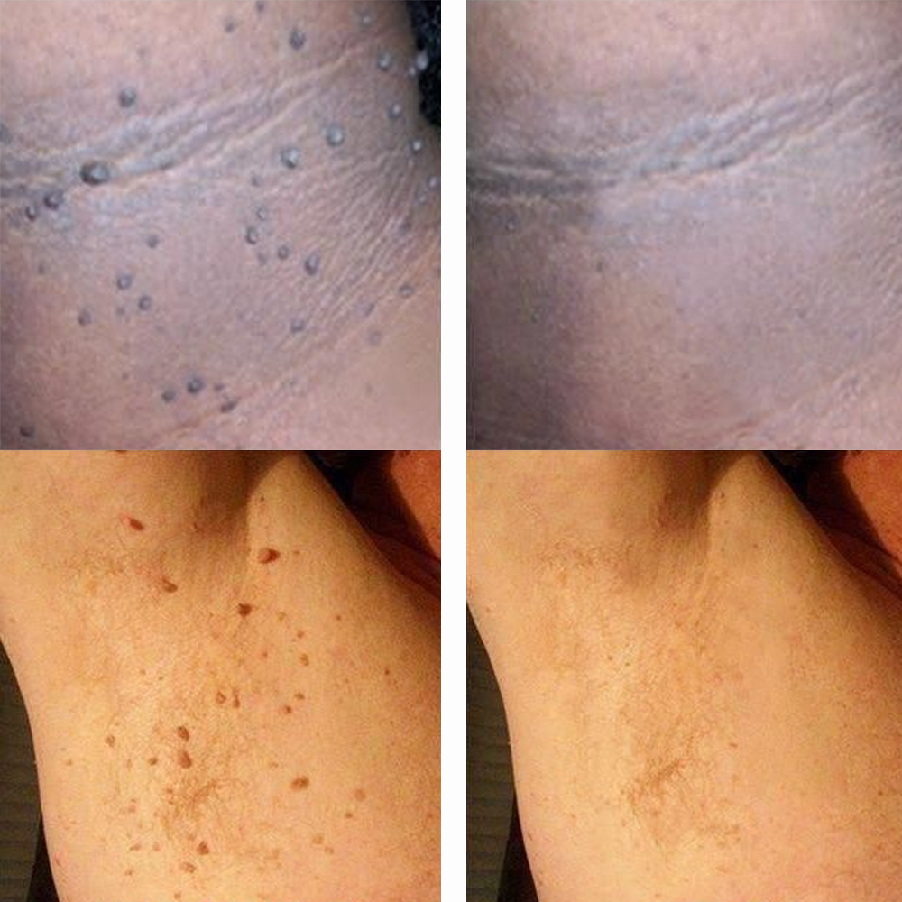 Nurbini® 💙Non-Invasive Mole & Wart Pen | Precision Care for Common Warts, Moles & Skin Tags