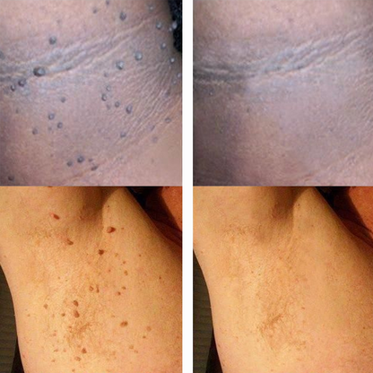 Nurbini® 💙Non-Invasive Mole & Wart Pen | Precision Care for Common Warts, Moles & Skin Tags